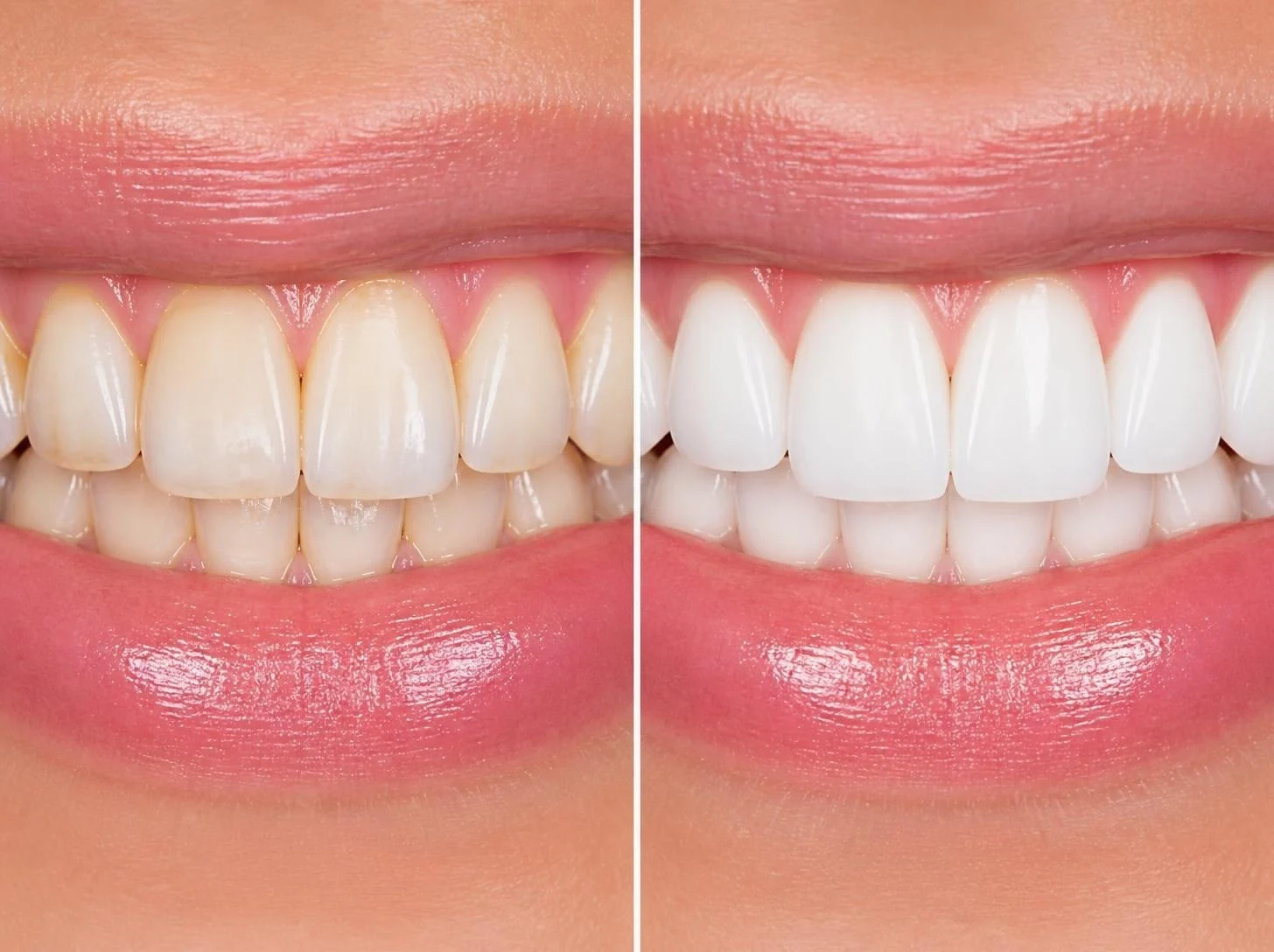 Prof. Dr. João Espírito Santo: os 6 cuidados a ter depois de um branqueamento dentário