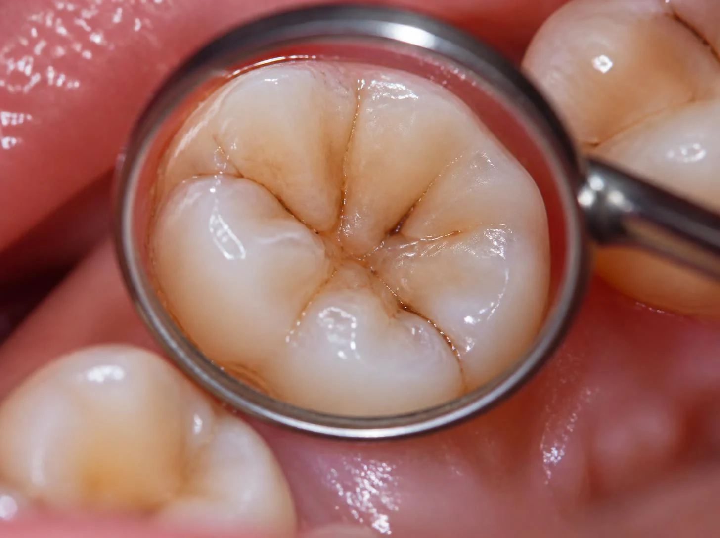 Prof. Dr. João Espírito Santo revela tudo o que precisa mesmo fazer para evitar ter cáries dentárias